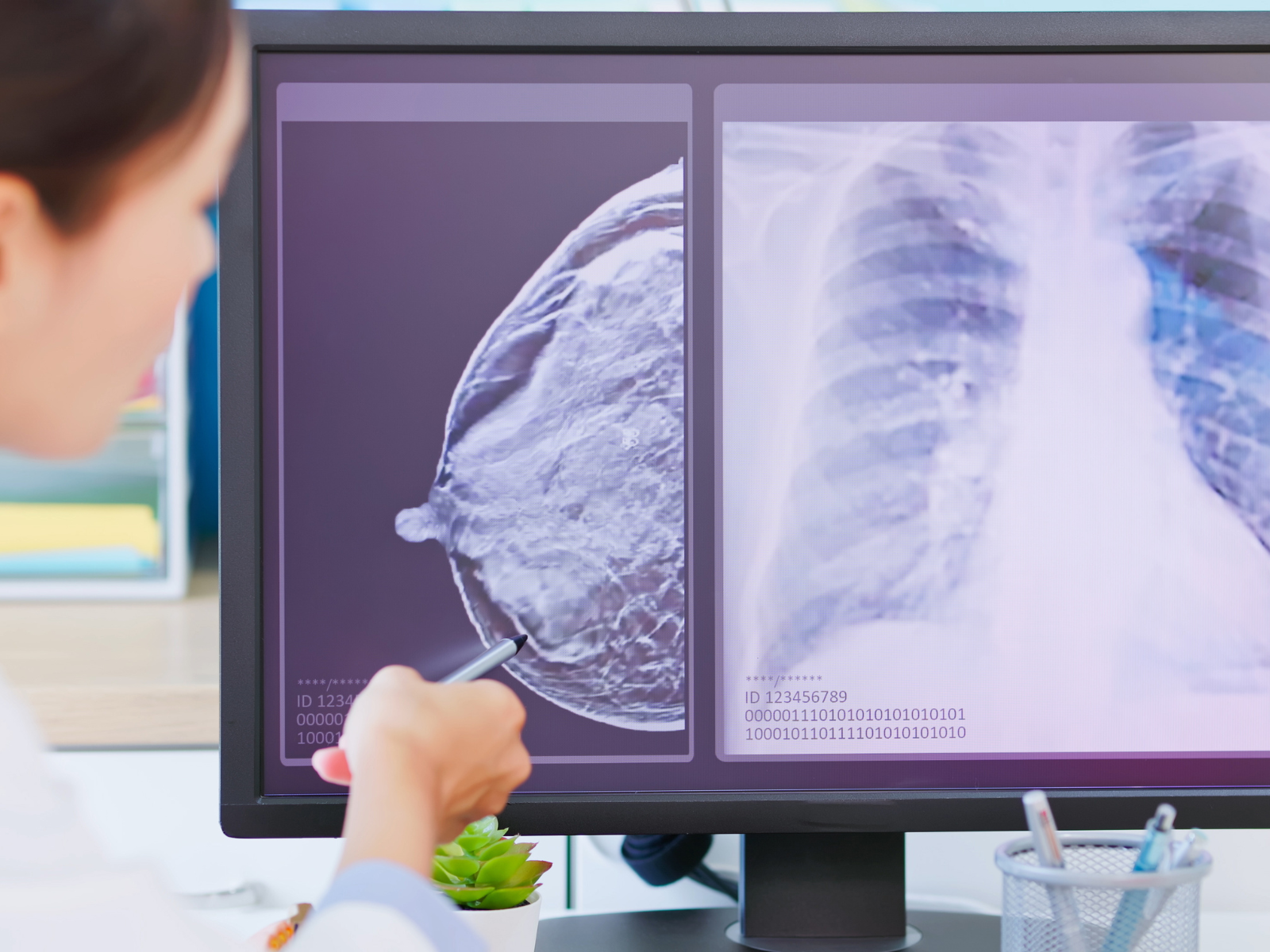 سرطان پستان و تشخیص زودهنگام